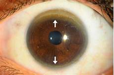 Slit lamp